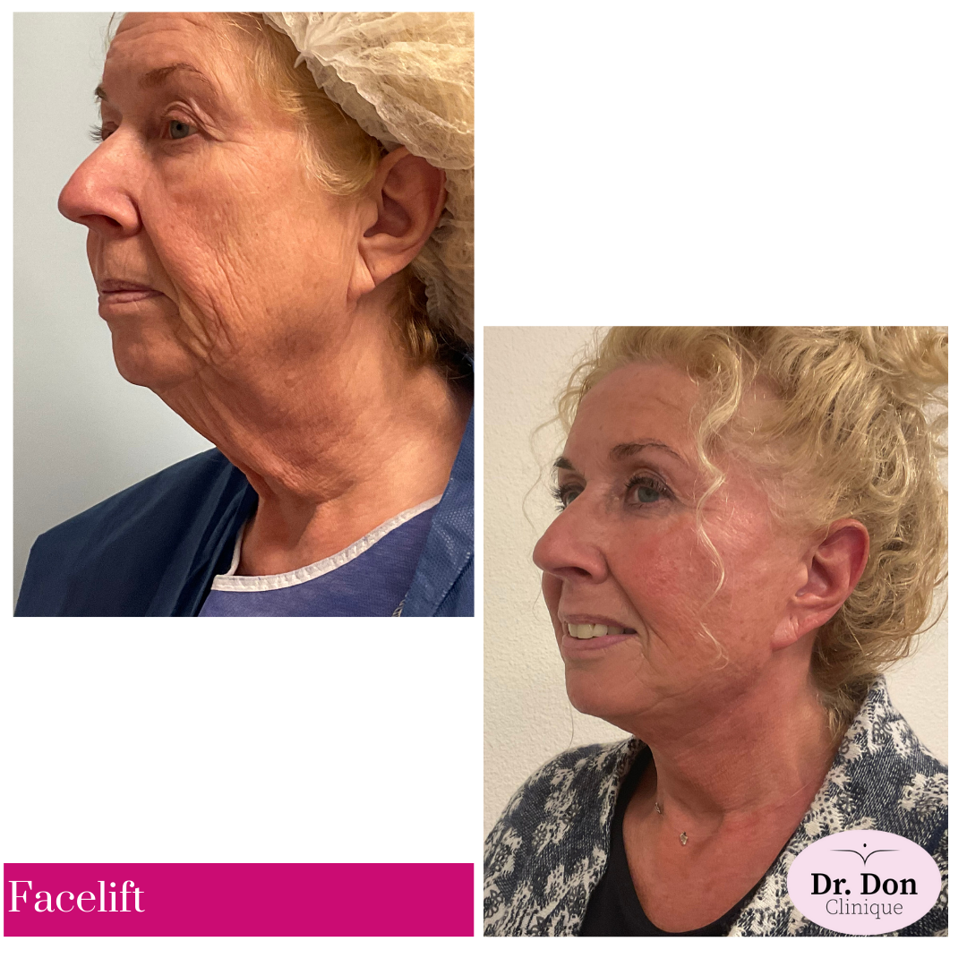 Facelift incl. uitgebreide halslift en bovenooglidcorrectie